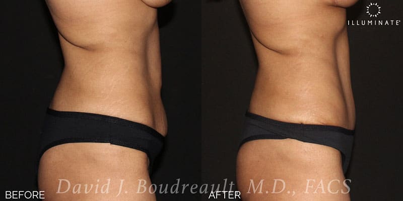 Tummy Tuck Before & After Image