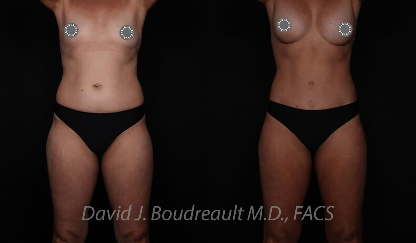 Tummy Tuck Before & After Image