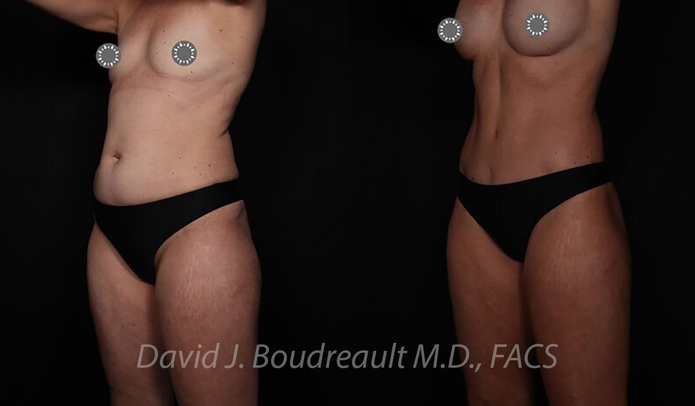 Tummy Tuck Before & After Image