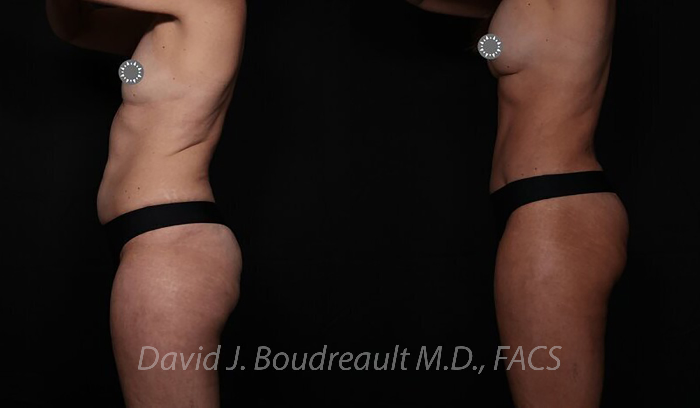 Tummy Tuck Before & After Image