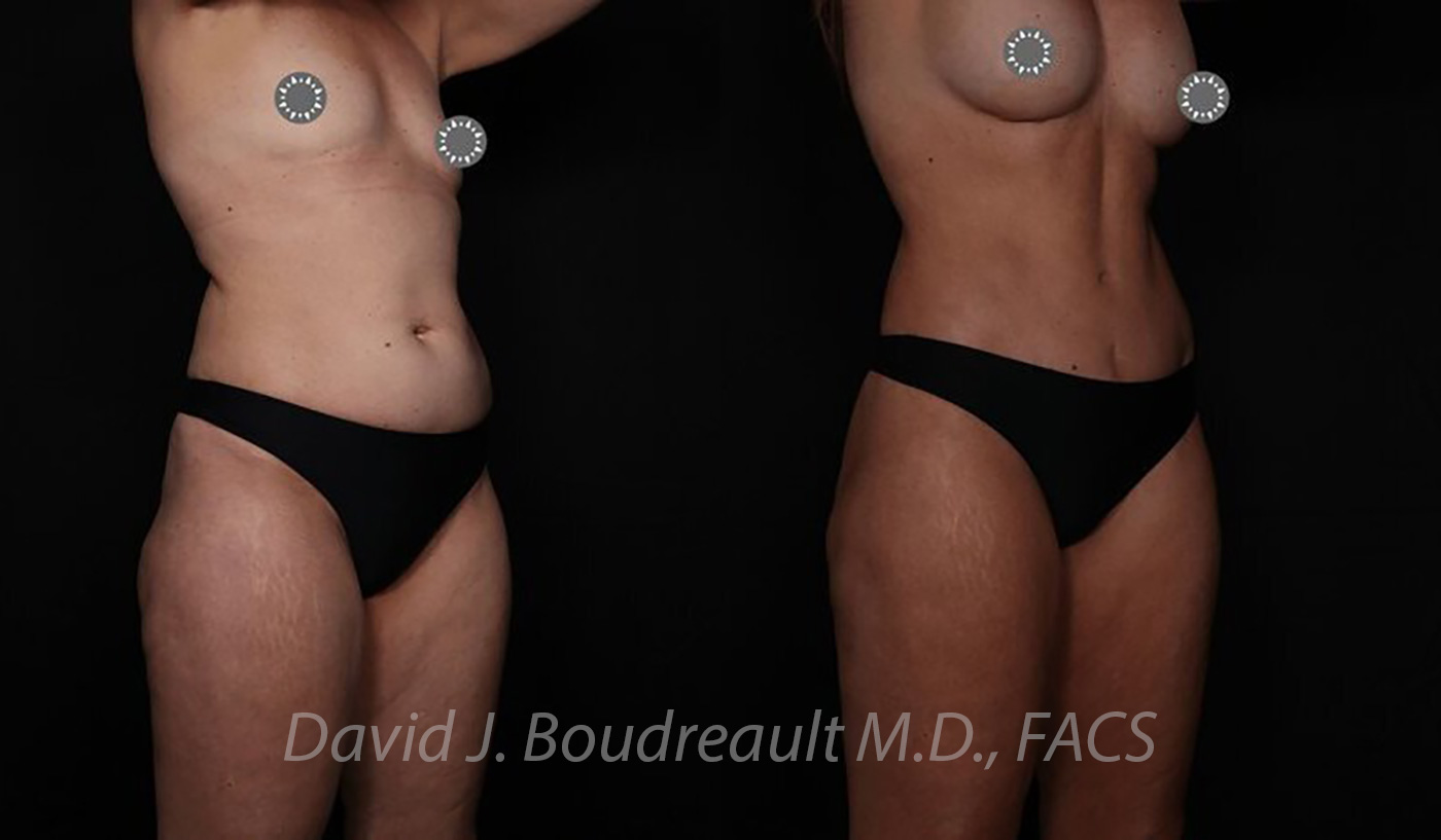 Tummy Tuck Before & After Image