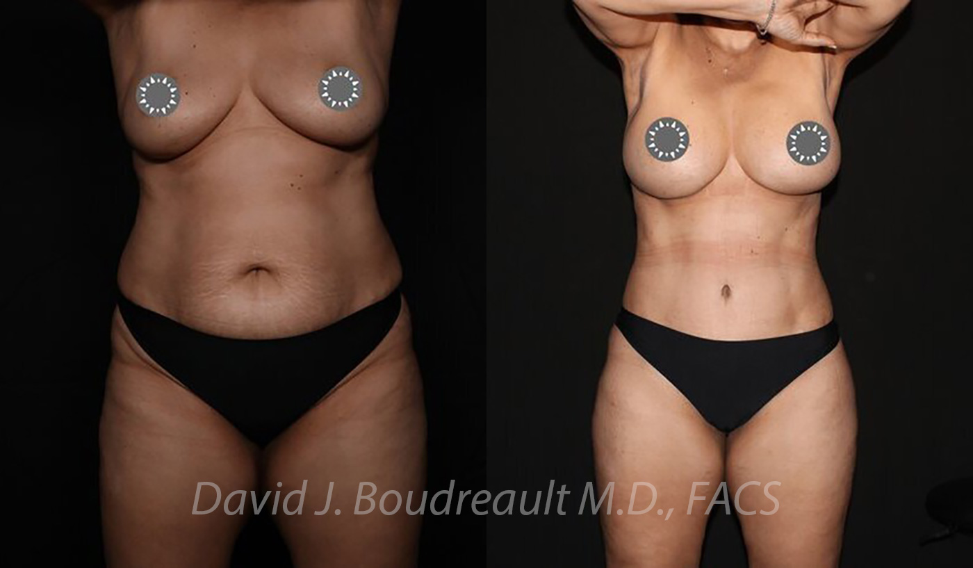 Tummy Tuck Before & After Image