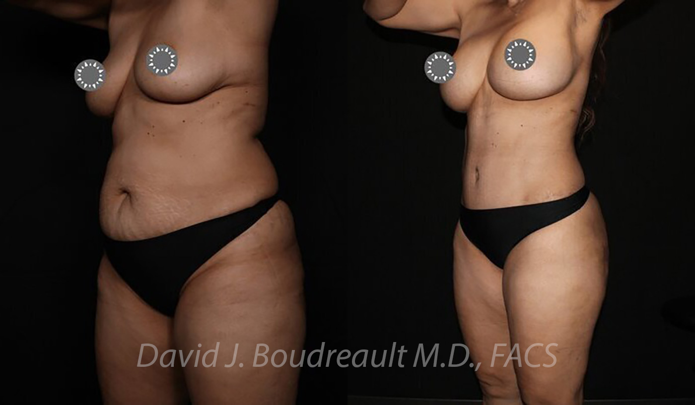 Tummy Tuck Before & After Image