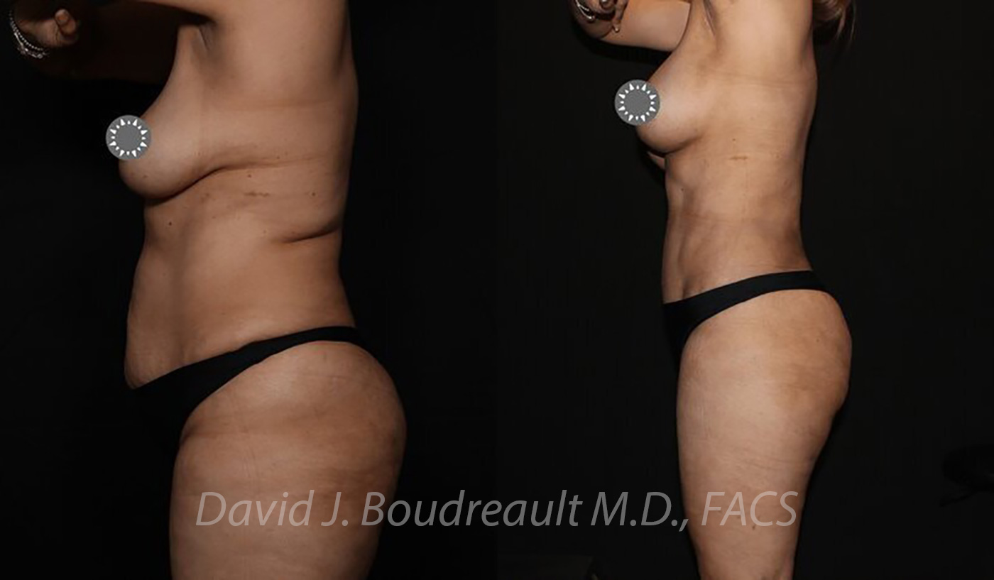 Tummy Tuck Before & After Image