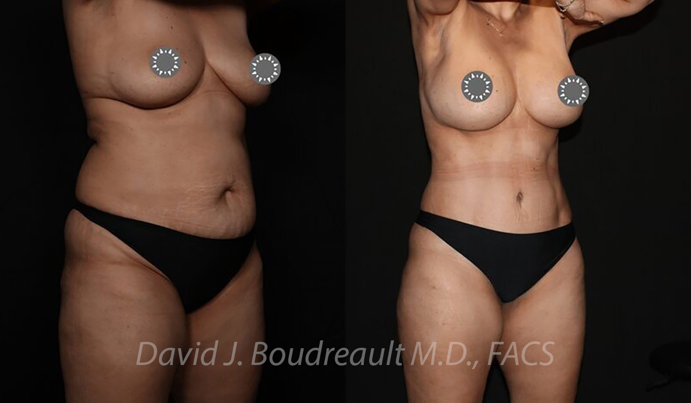 Tummy Tuck Before & After Image