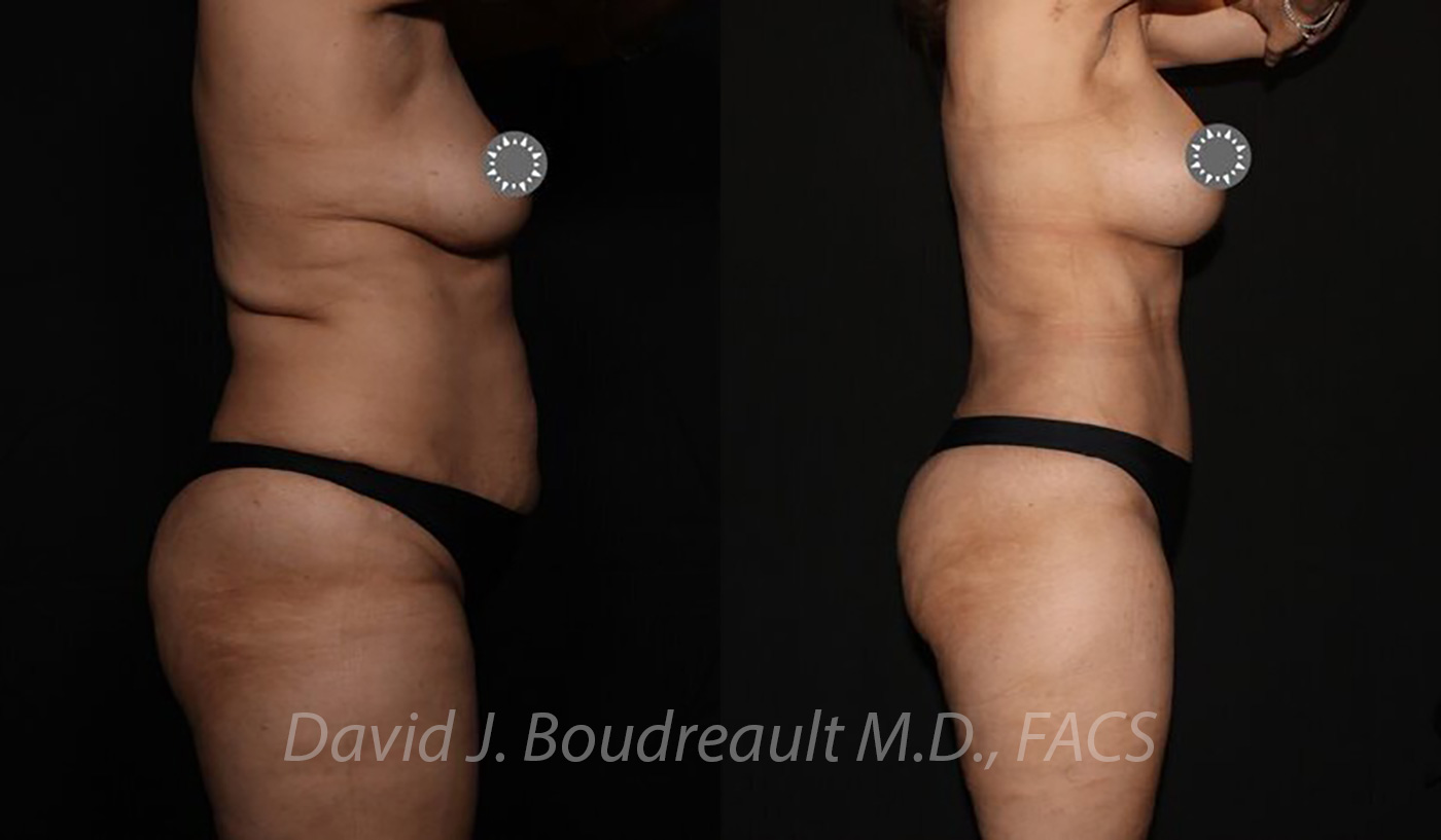 Tummy Tuck Before & After Image