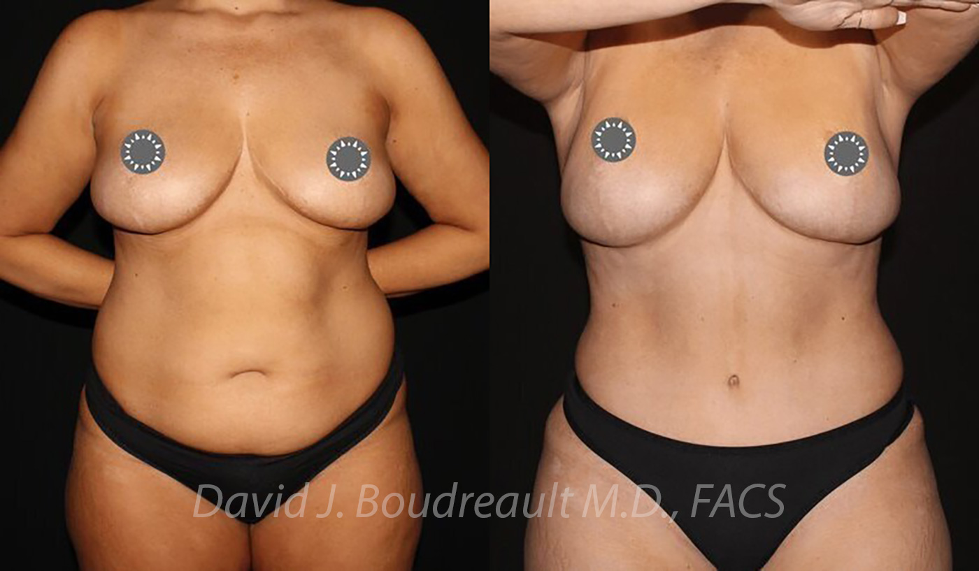 Tummy Tuck Before & After Image