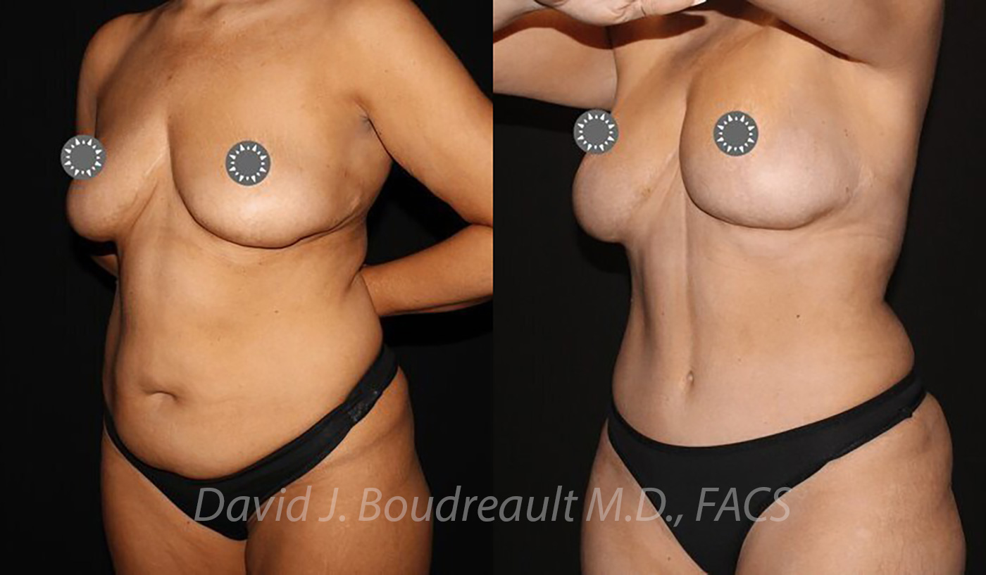 Tummy Tuck Before & After Image