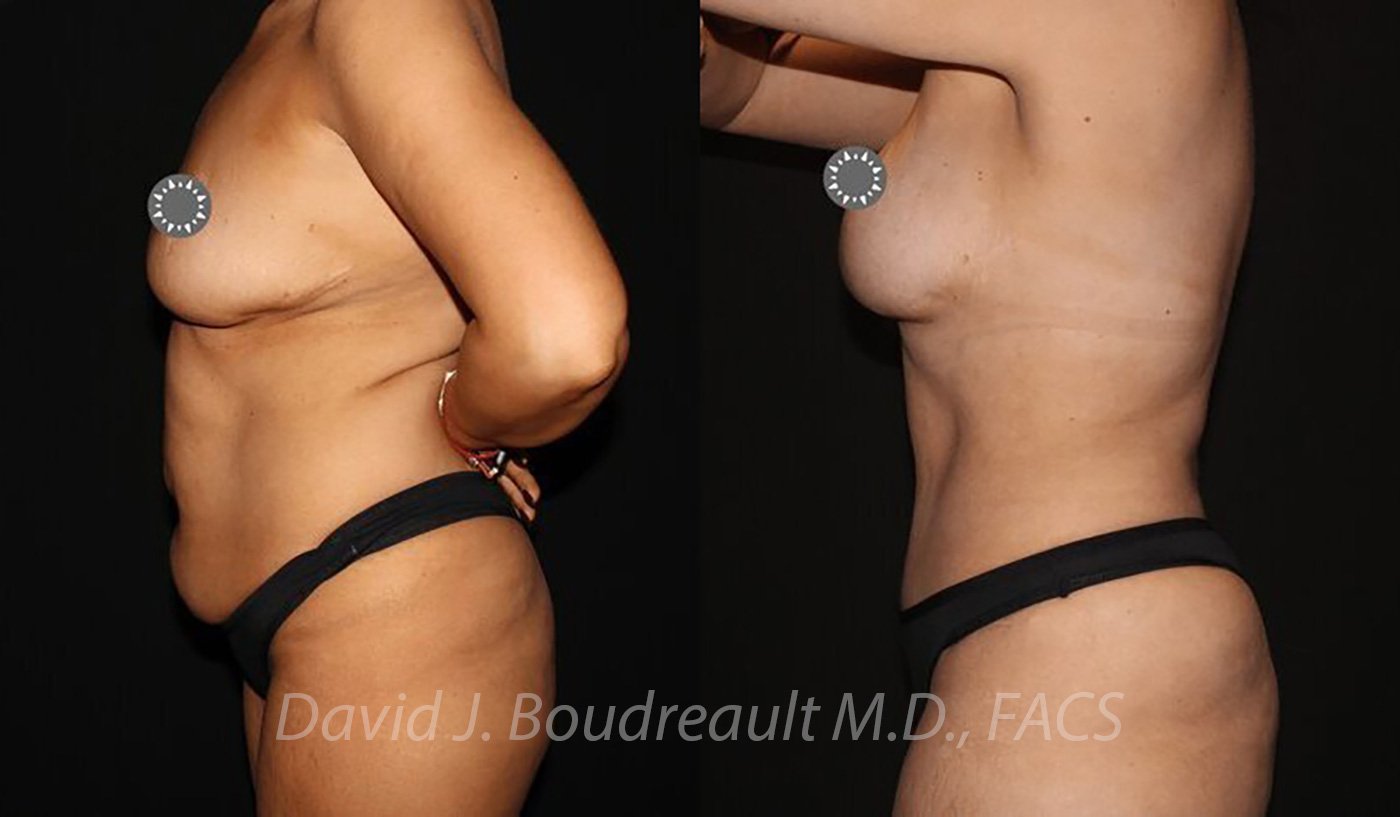 Tummy Tuck Before & After Image