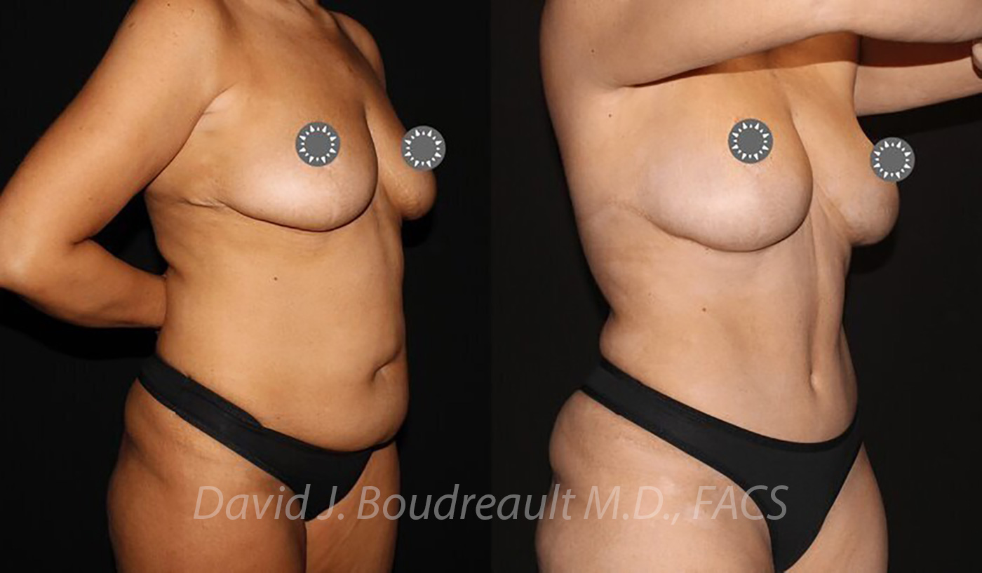 Tummy Tuck Before & After Image