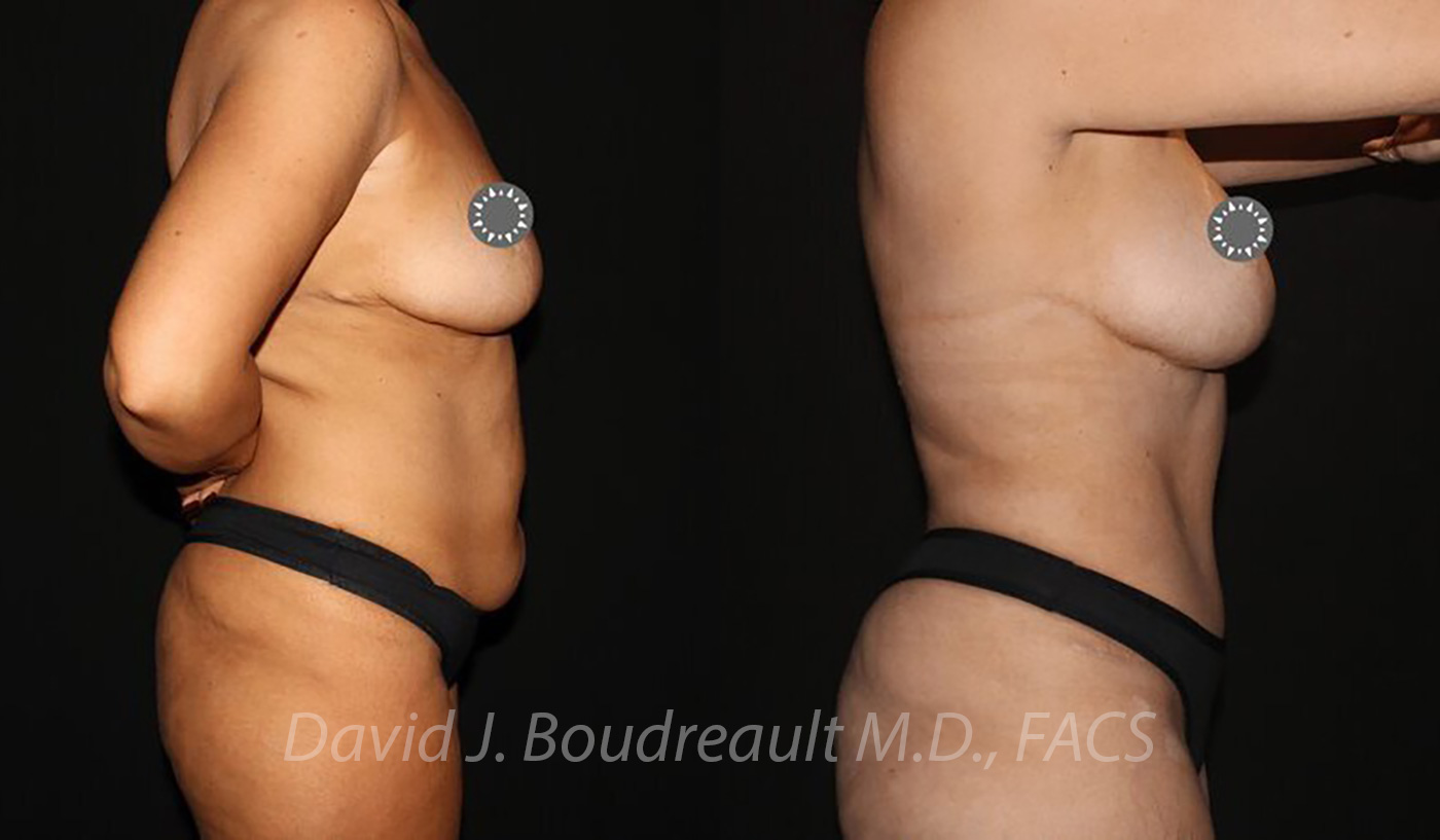 Tummy Tuck Before & After Image