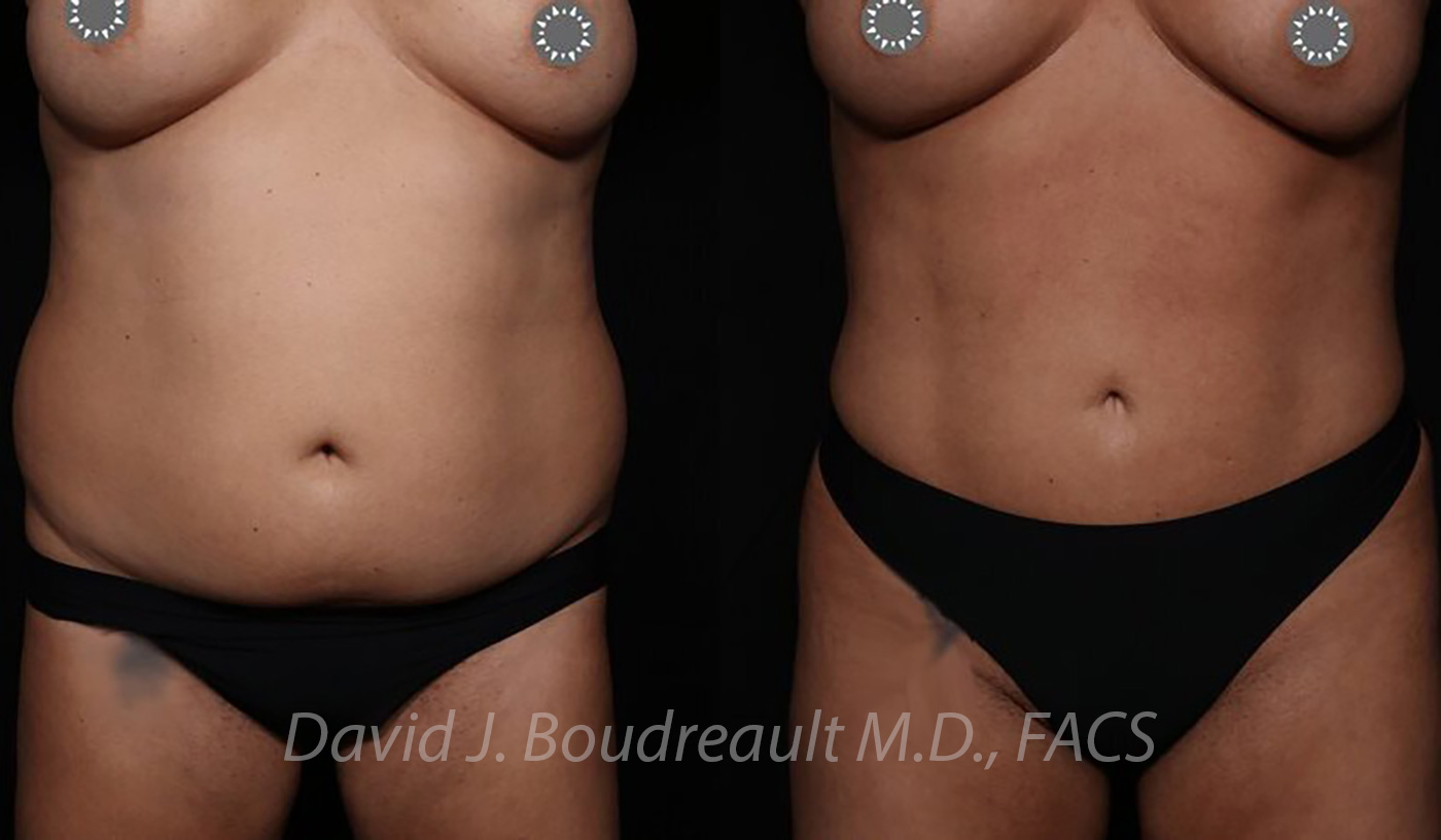 Tummy Tuck Before & After Image