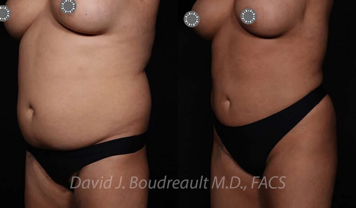 Tummy Tuck Before & After Image