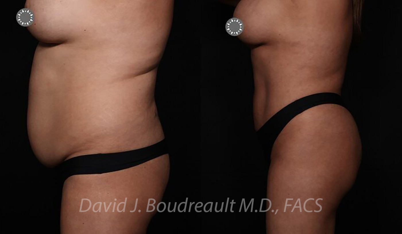 Tummy Tuck Before & After Image