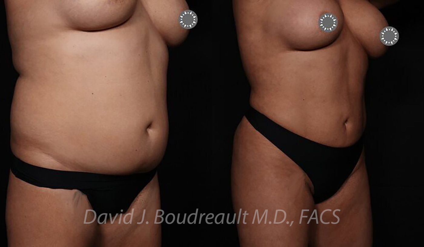 Tummy Tuck Before & After Image