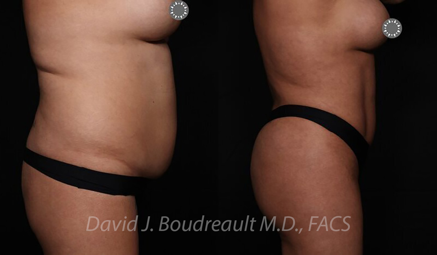 Tummy Tuck Before & After Image