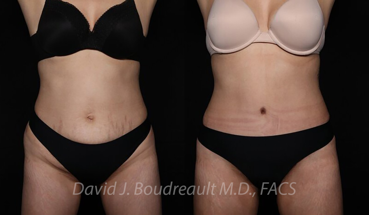 Tummy Tuck Before & After Image