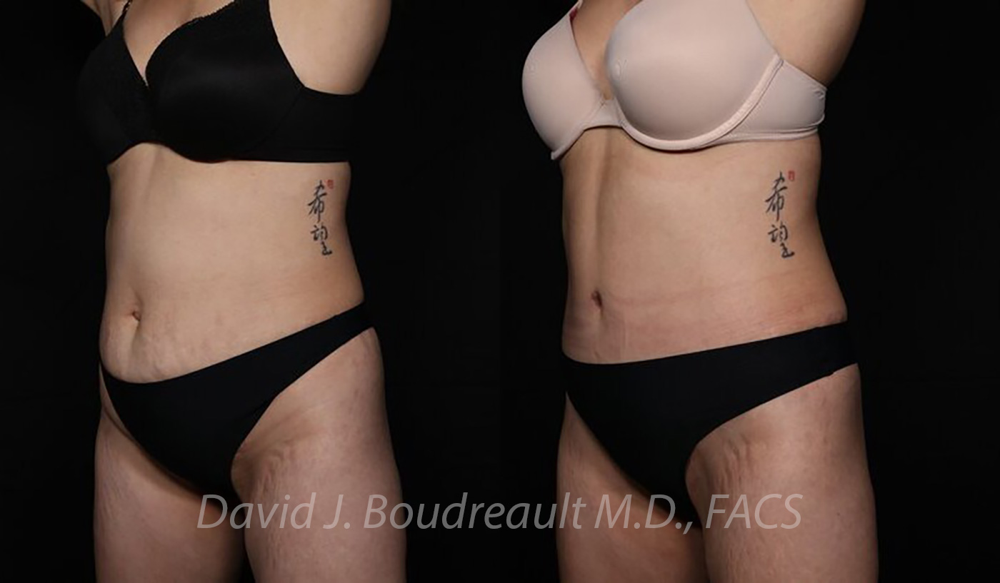 Tummy Tuck Before & After Image