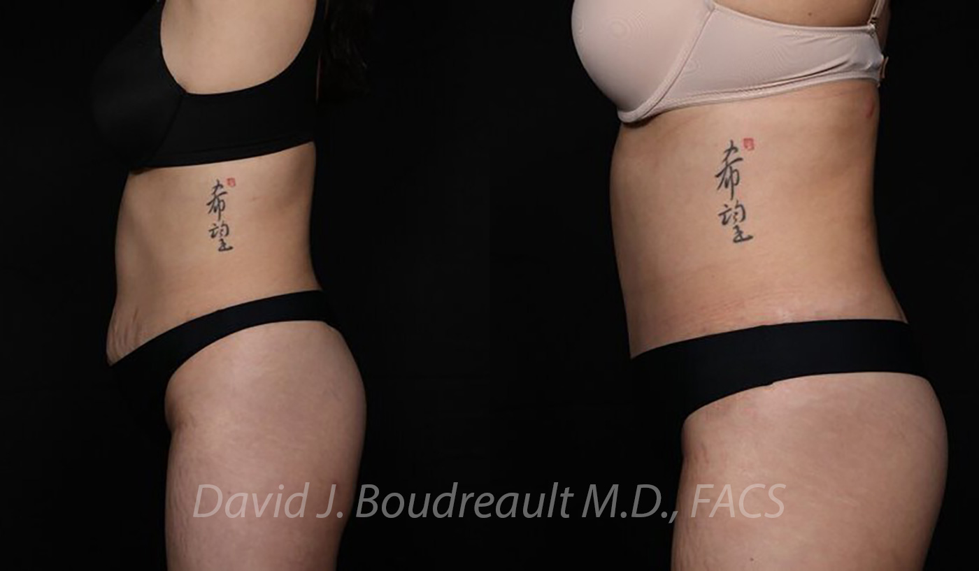Tummy Tuck Before & After Image
