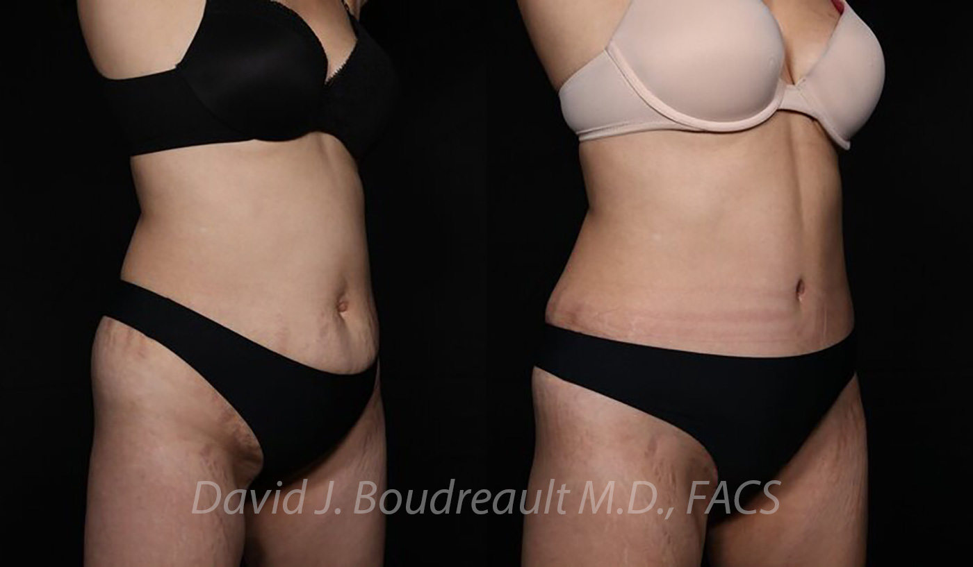 Tummy Tuck Before & After Image