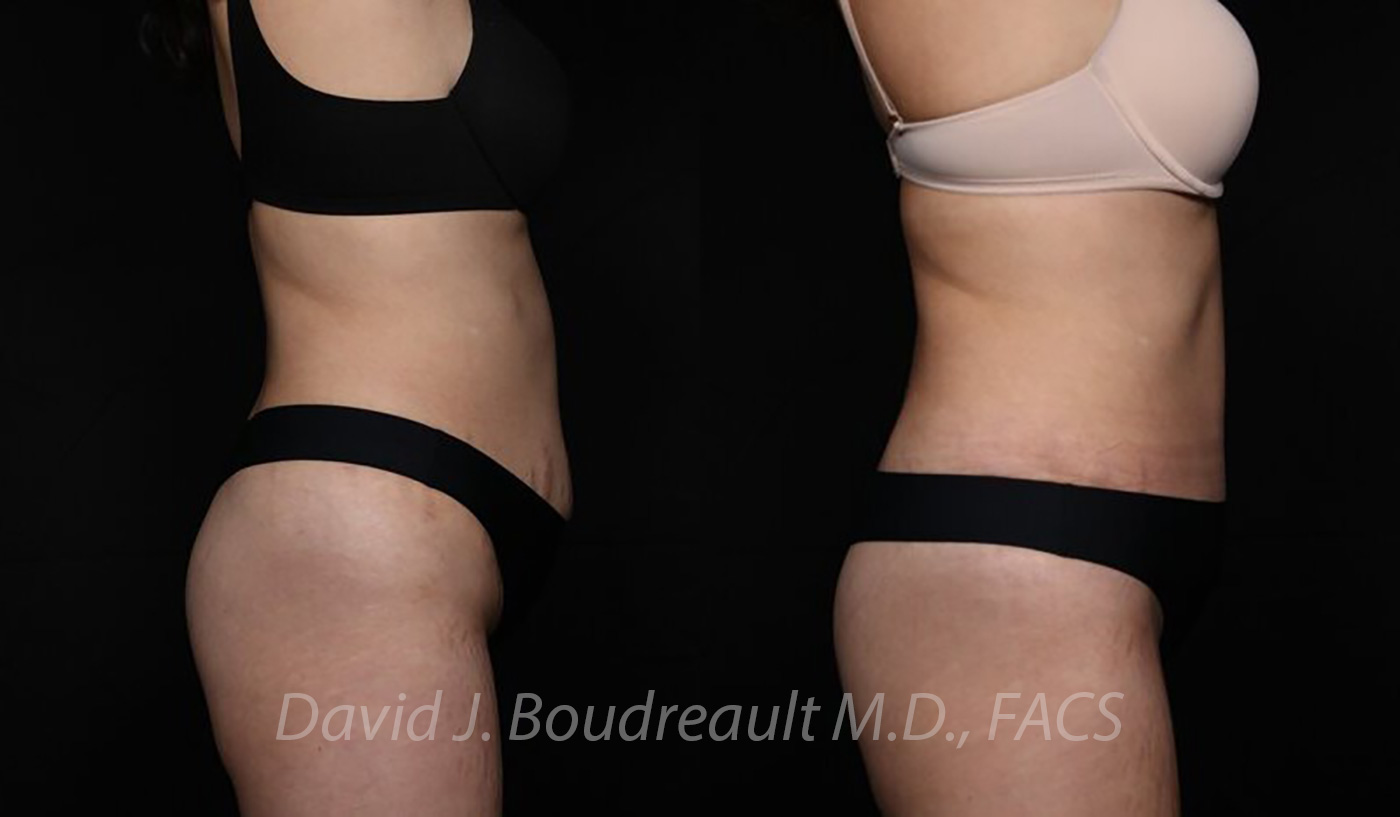 Tummy Tuck Before & After Image