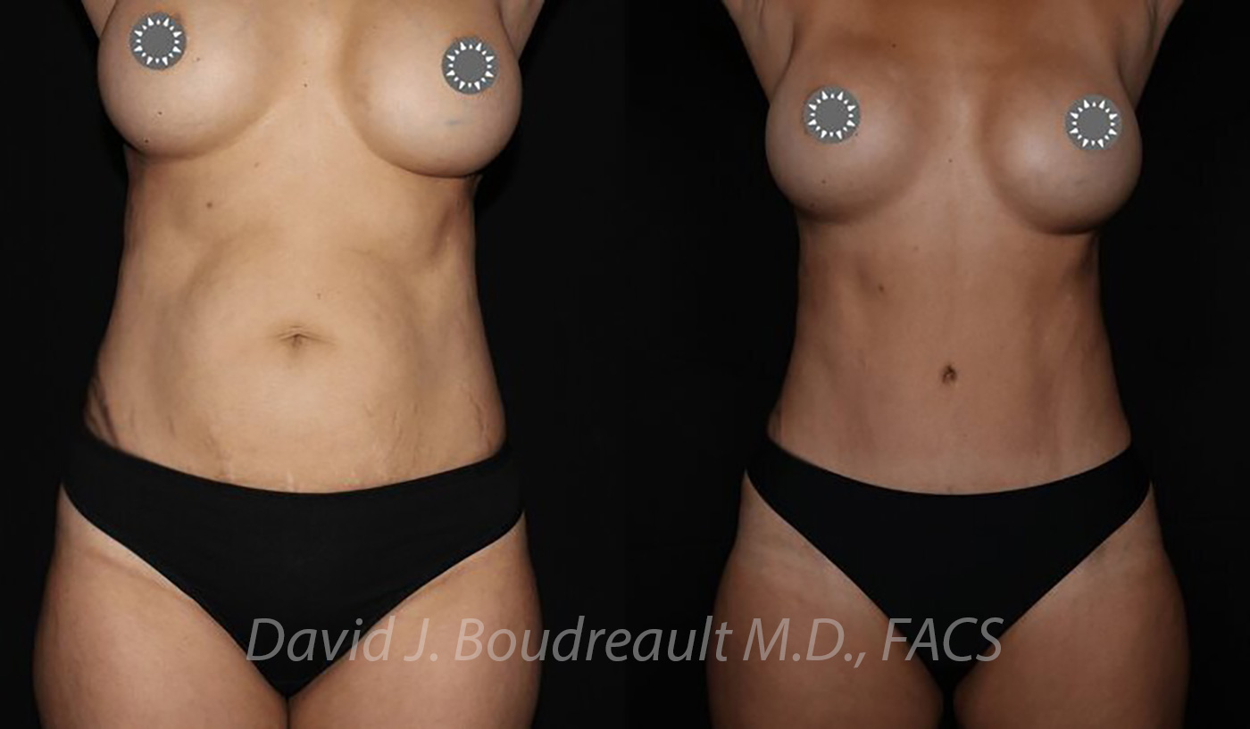 Tummy Tuck Before & After Image