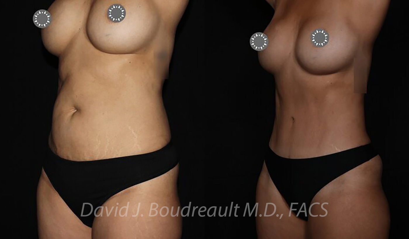 Tummy Tuck Before & After Image