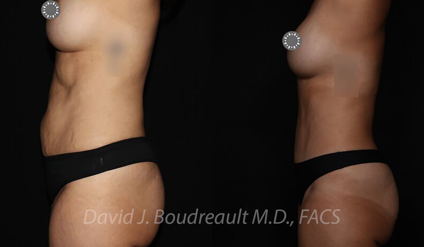 Tummy Tuck Before & After Image