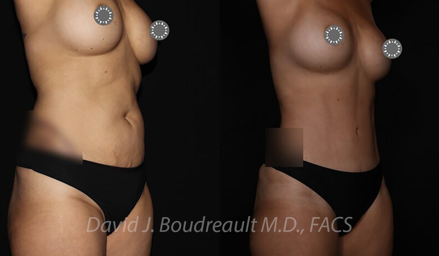 Tummy Tuck Before & After Image