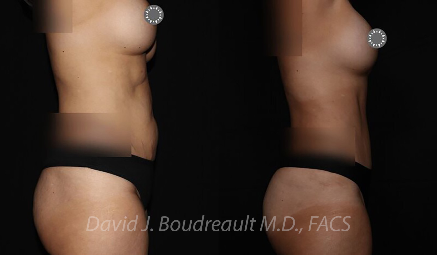 Tummy Tuck Before & After Image