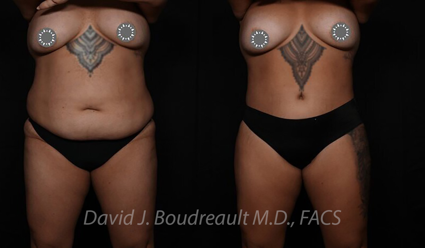 Tummy Tuck Before & After Image