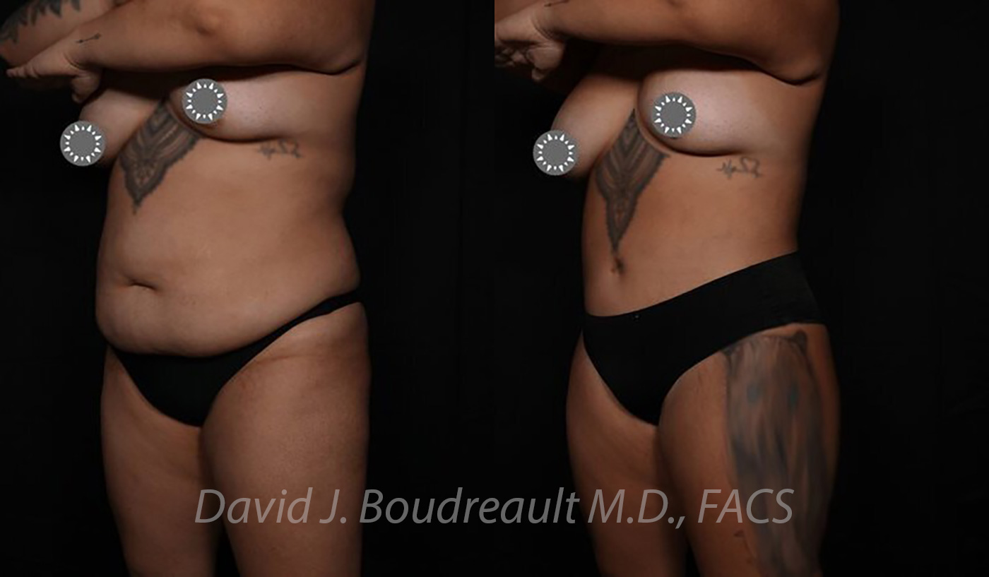 Tummy Tuck Before & After Image