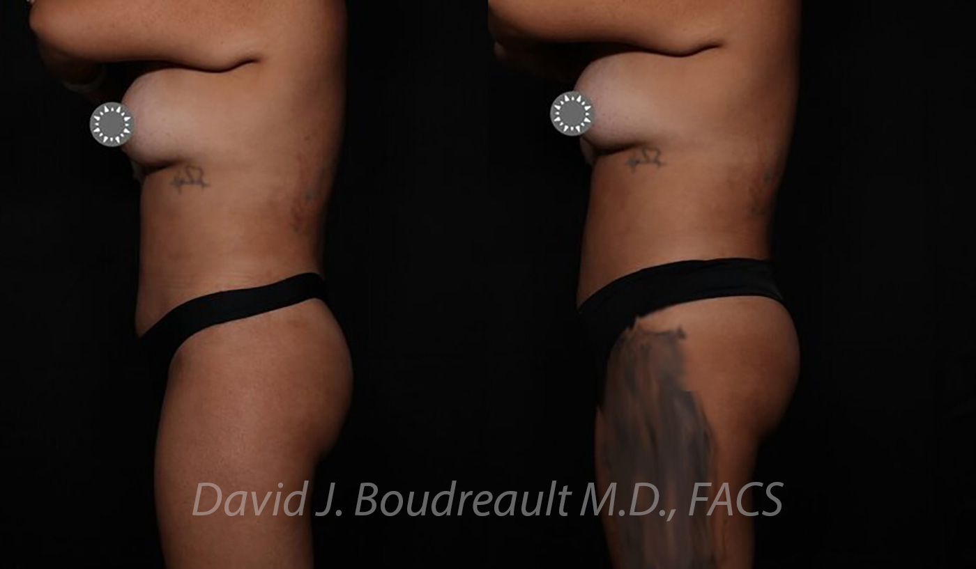 Tummy Tuck Before & After Image