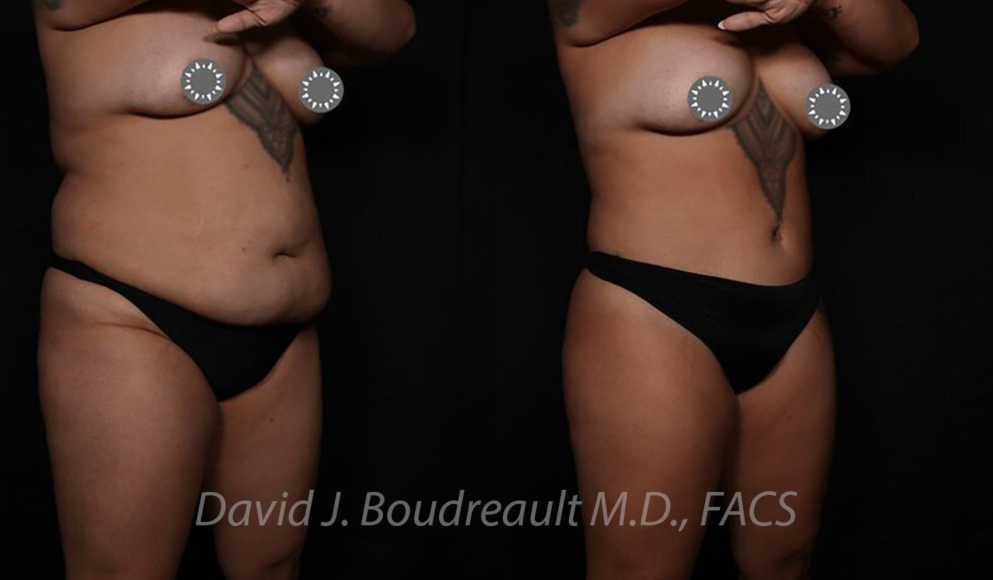 Tummy Tuck Before & After Image