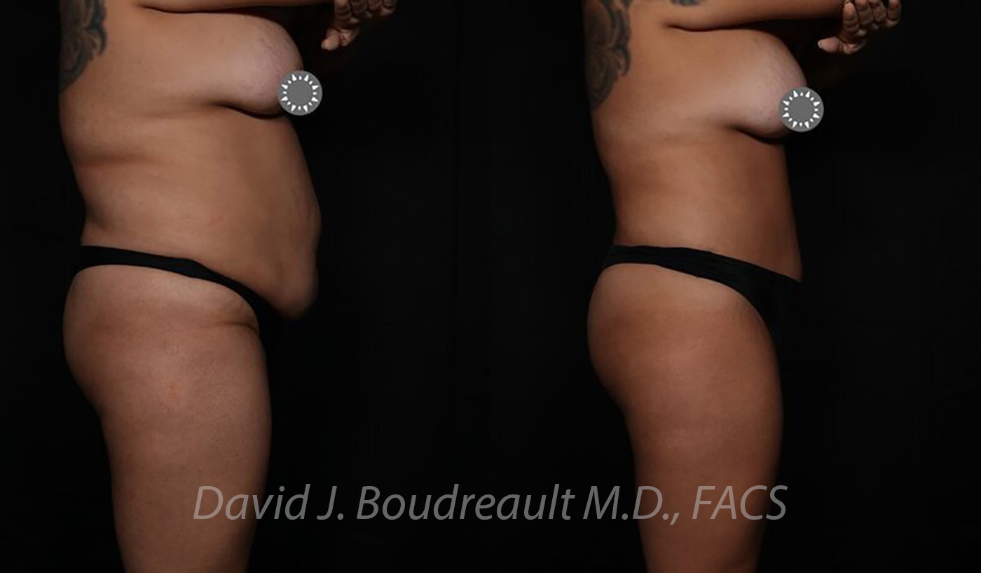 Tummy Tuck Before & After Image
