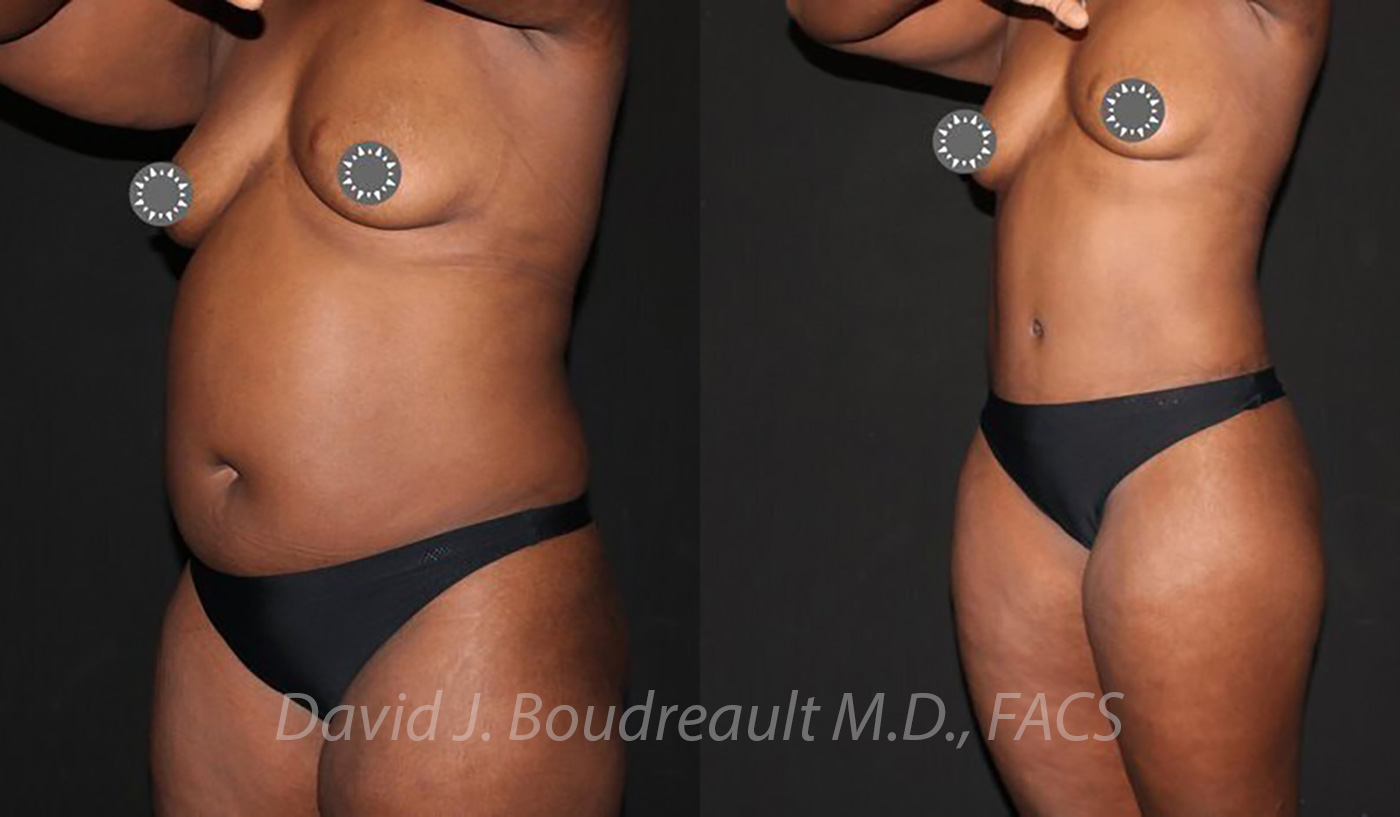 Tummy Tuck Before & After Image