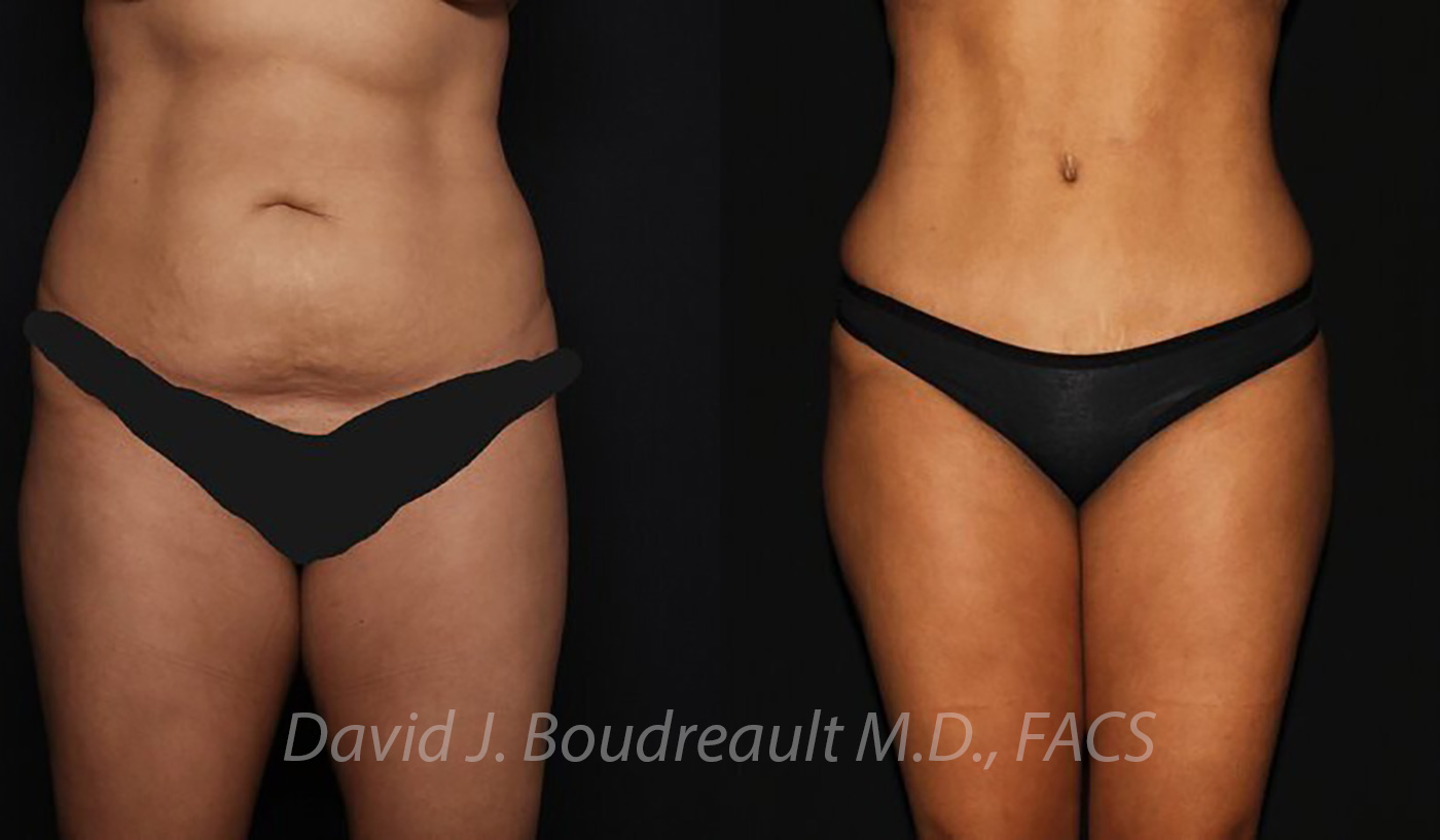 Tummy Tuck Before & After Image