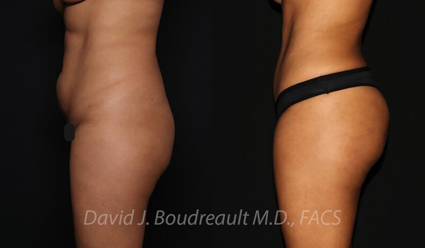 Tummy Tuck Before & After Image