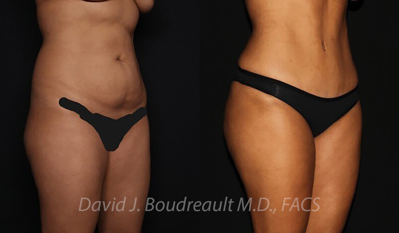 Tummy Tuck Before & After Image