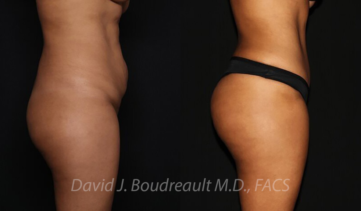 Tummy Tuck Before & After Image
