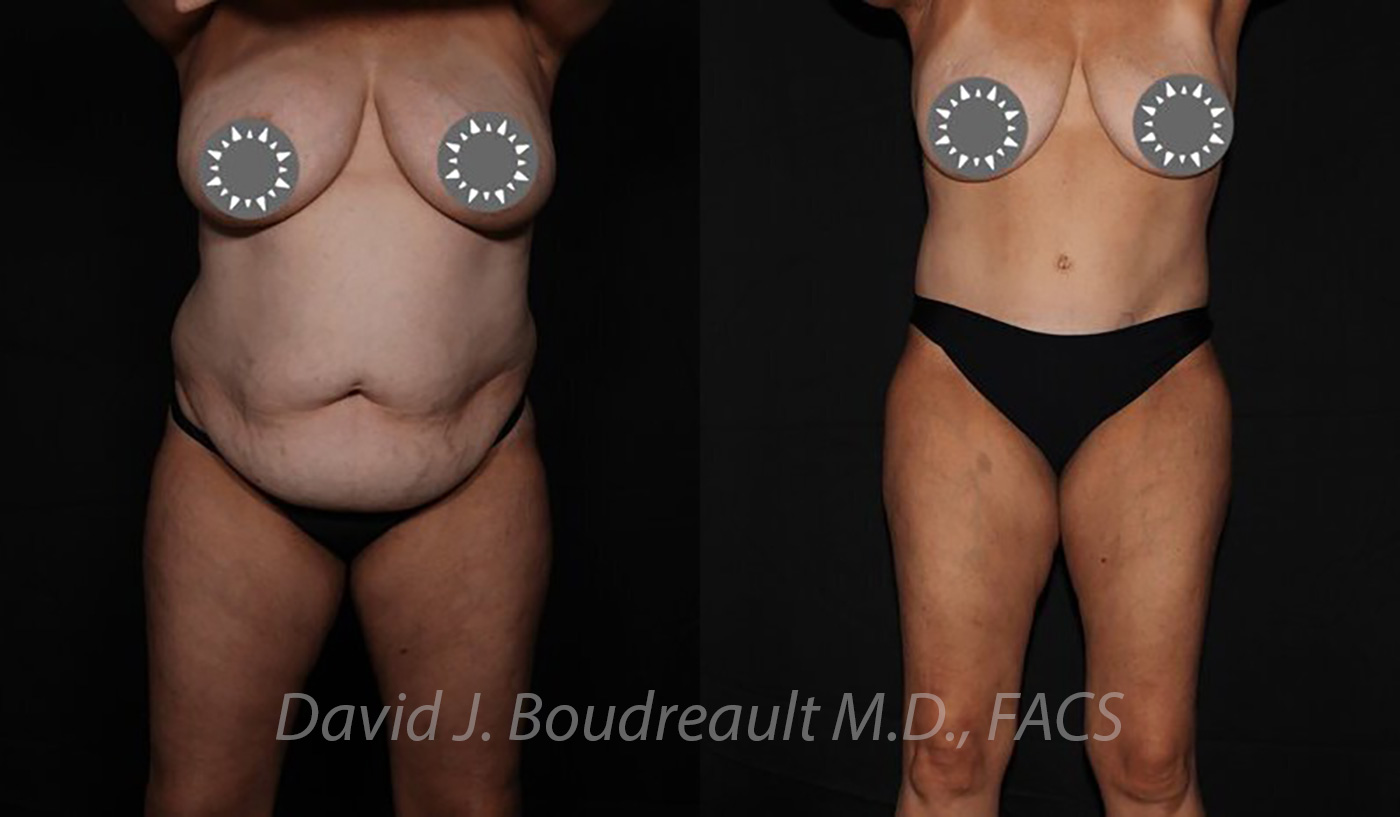 Tummy Tuck Before & After Image