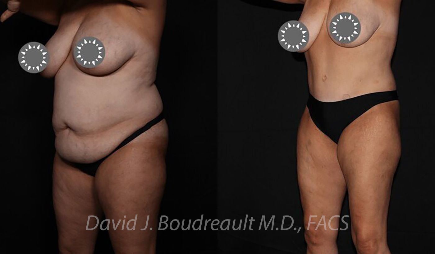 Tummy Tuck Before & After Image