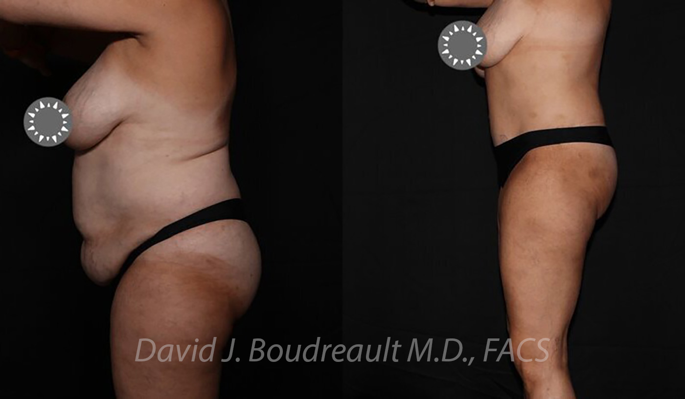 Tummy Tuck Before & After Image