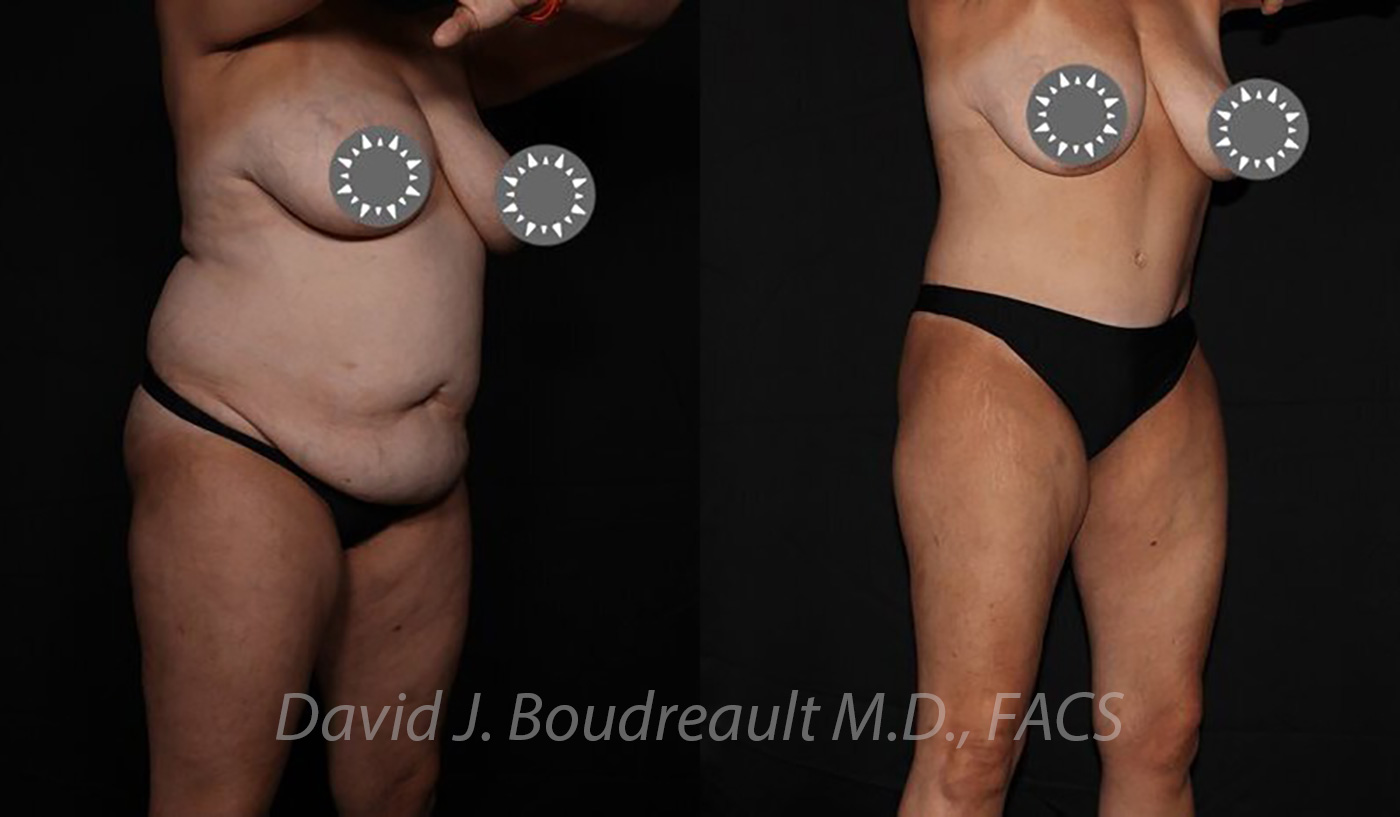 Tummy Tuck Before & After Image