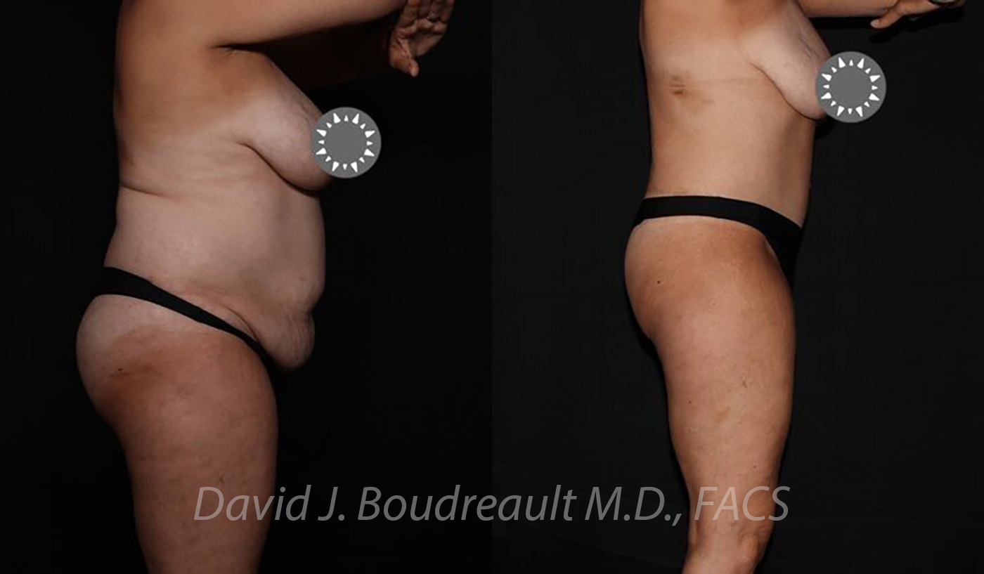 Tummy Tuck Before & After Image