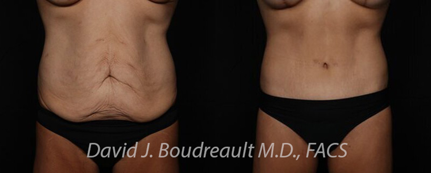 Tummy Tuck Before & After Image