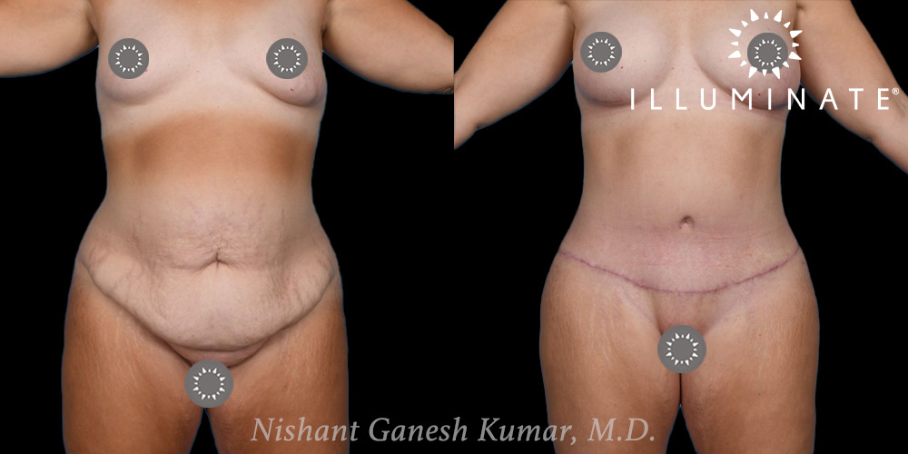 Tummy Tuck Before & After Image