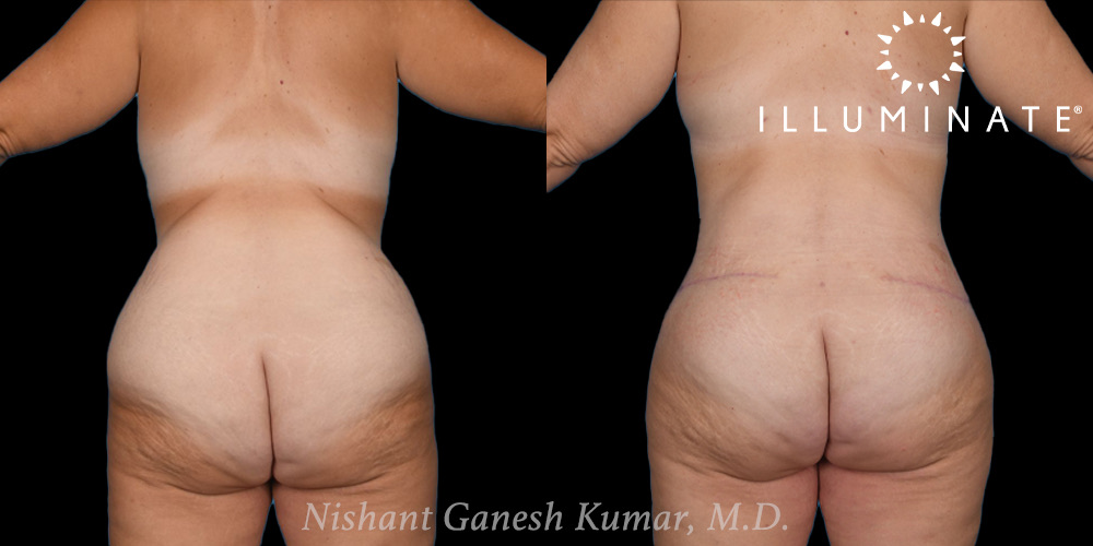 Tummy tucks Before & After Image