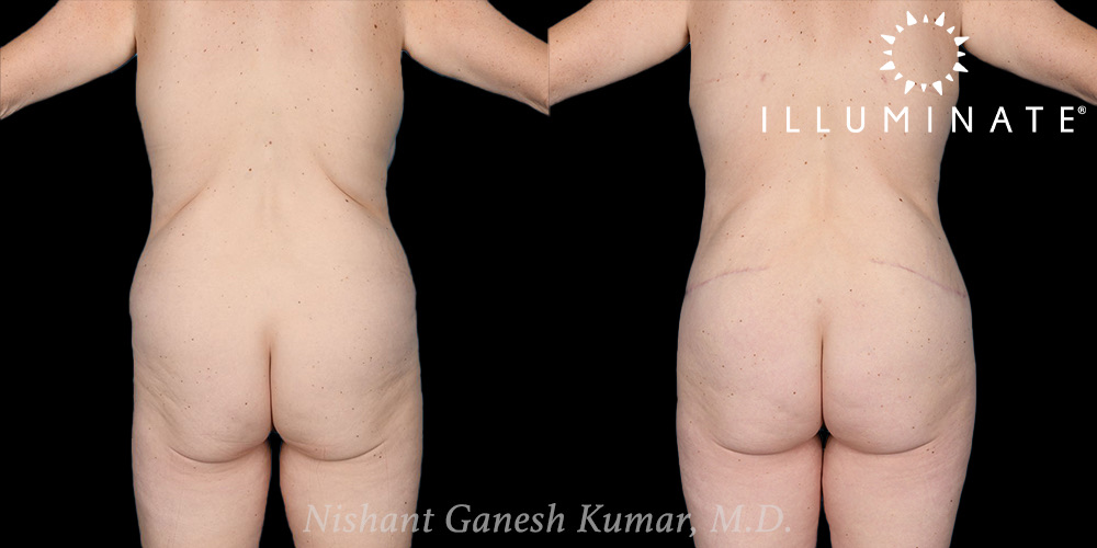 Tummy Tuck Before & After Image