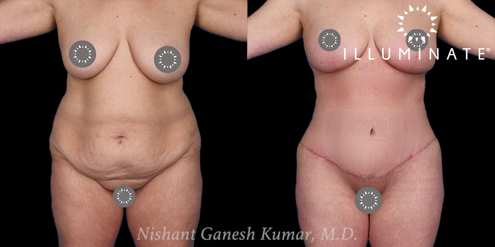 Tummy Tuck Before & After Image